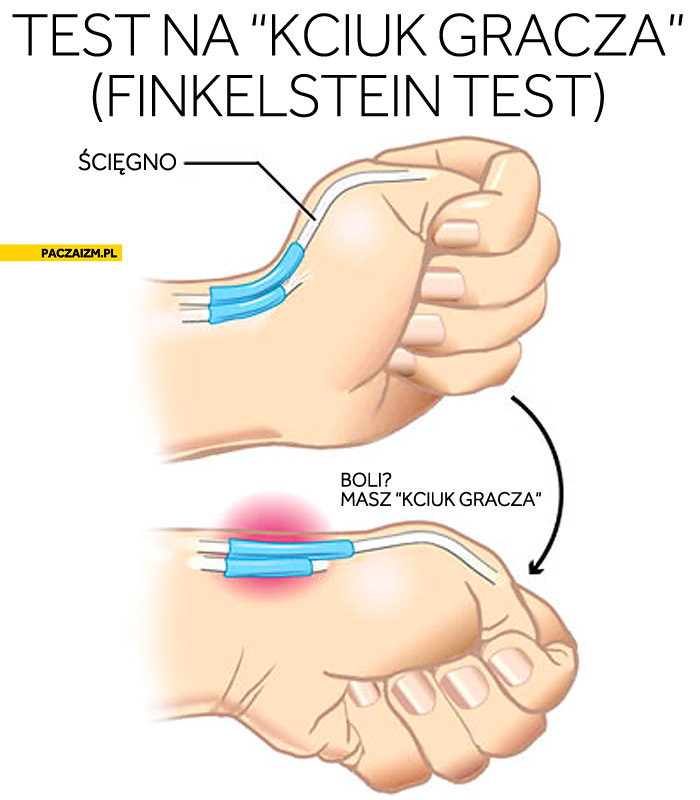 Test na kciuk gracza Finkelstein test