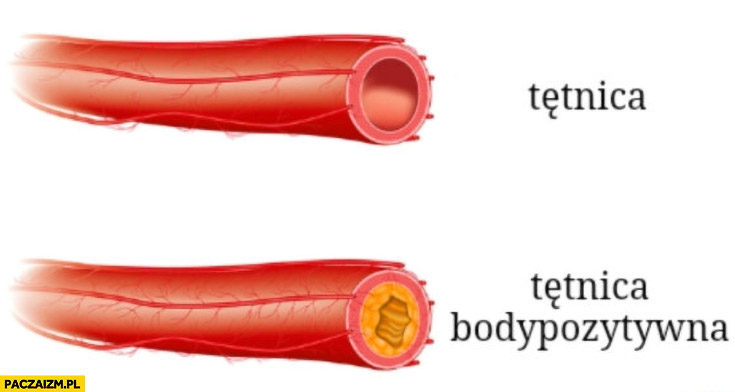 Tętnica vs tętnica bodypozytywna zapchana porównanie